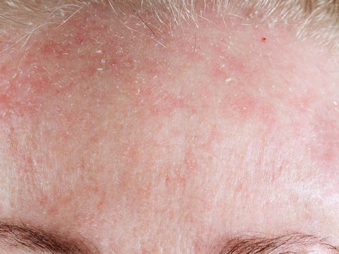 Optimal Remedies for Flaky Skin on Face from Rosacea and Dandruff