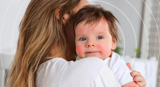 Restore Skin Barrier Internally to Combat Childhood Eczema